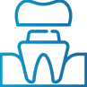 Dental Bridges